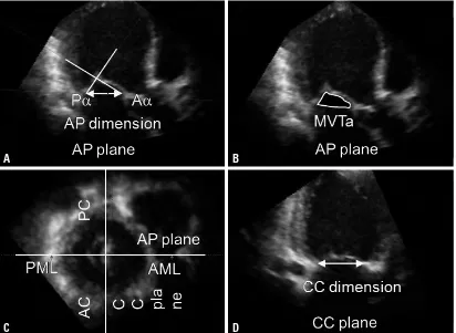 Fig. 1. Illustrations explaining geometric measurements of the mitral tethering angle (A), mitral valve tenting area (B), cross-sectional vol-umetric image at the mitral valve level (C), and CC plane (D) connecting both commissures