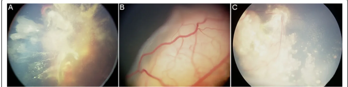 Fig. 1 Representative images of fundus examinations. a, Left fundus of one 3-year-old girl showed a large tumor space occupying with hemorrhage under the retina, wildly vitreous cavity seeding, and partial detachment of retina