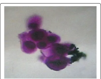 Fig. 3 Representative image of CSF cytology in unilateral RB patients with intracranial segment of retrobulbar optic nerve invasion.