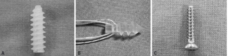 Fig. 1. Graft preparation using Krackow whip stitches, forming four loops at each end of the tendon