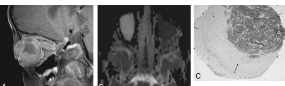 Fig 2. Unilateral medium-sized well-differentiated retinoblastoma. A, Axial T2-weighted image shows hypointense mass in the right globe, measuring 10 mm