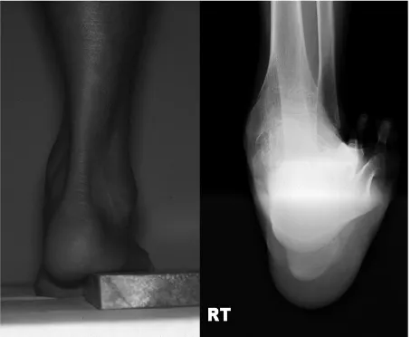 Fig. 1. Hindfoot flexibility was confirmed by the clinical and radiological Coleman block test.