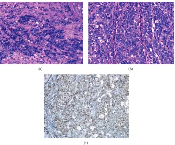 Figure 5: p53 gene sequences in exon 5–8 were analyzed. No alteration was identified in adenocarcinoma cells (a); in contrast, a transitionalmutation (A to C) was identified in codon 179 of exon 5 in endocrine cells (b).