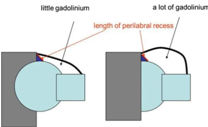 Fig. 6 Schematic showing the influence of joint distention. The fixed origin and insertion of the capsule remain unchanged independent of the amount of applied intraarticular fluid