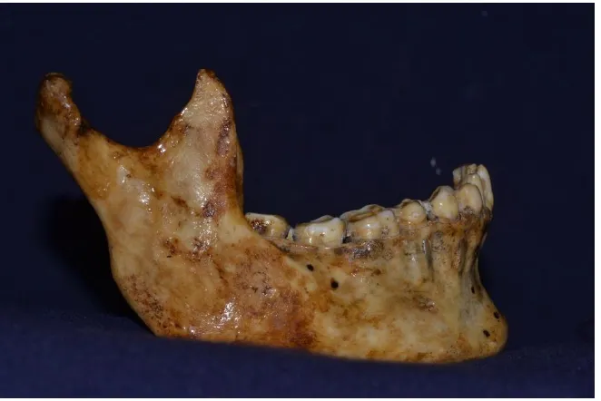Fig 2, 3: (from left to right) CT scan of the mandible converted into 3D model 