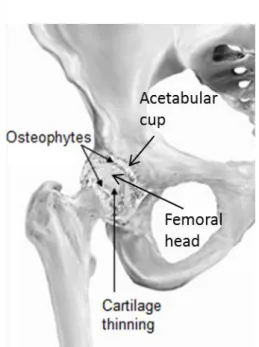 Figure 1-22 Arthritic hip. An osteoarthritic hip with osteophyte formations, adapted from  Kennon (2008)