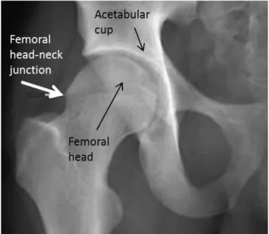 Figure 1-23 Pistol grip deformity. The white arrow highlights the aspherical section of the  femoral head-neck junction, taken from Robinson (2010)