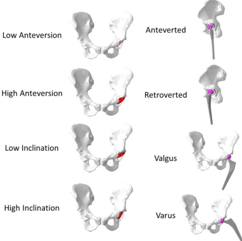 Figure 1.1: Alignment variables of the acetabular THA component (Left) and femoral  THA component (Right) 