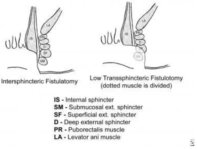 Fig 6: Illustration of lay open fistula surgery for fistula in ano 