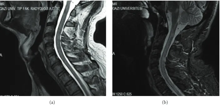 Figure 3: (a) Normal cervical MRI, T2 weighted sagittal section, (b) demyelinating posterior and posterolateral cord lesions in C1, C4, andC5-6 intervertebral disc levels and in upper thoracic segments, T2 weighted sagittal section, and control cervical MRI.