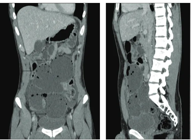 Figure 1: Macroscopic appearance of the ileal diverticula (a) (arrows) and multiple mesenteric cysts (b) (arrows).