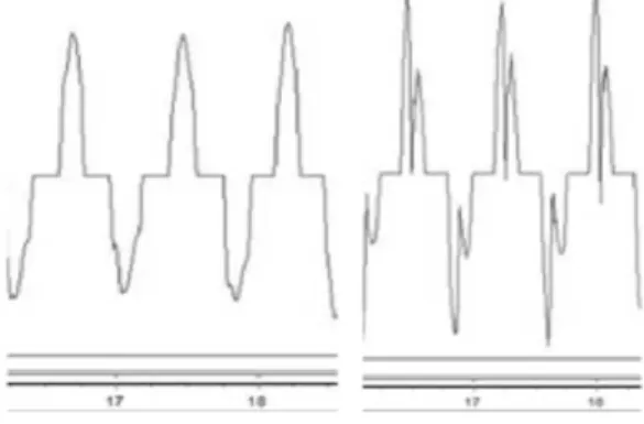 Figure 5: The  differentiated minimod signal at a  speed of 120 bpm. Left: solid weight