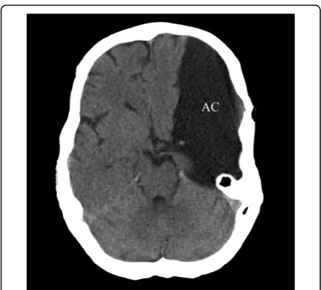Figure 1 Radiological presentation of an arachnoid cyst (AC)Computed tomography (CT) scan of a large, left-sided temporal AC.Note the splitting of the Sylvian fissure and the compression of thefrontal and temporal lobes, all classical features of a Galassi