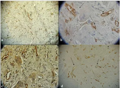   Figure 1a: Blood vessels immunostained by anti-CD34 antigen in CGCG (Nikon light microscope 400×),  b: Blood vessels and stromal cells immunostained by anti-CD34 antigen in PGCG (Nikon light microscope 1000×),  c: Blood vessels and stromal cells im-