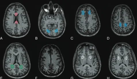Fig 1. White and gray matter ROIs used for calculating DTI metrics in a single subject