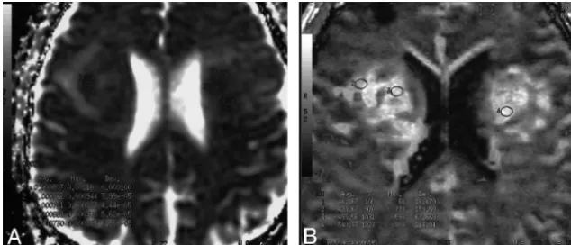 Fig 1. A 62-year-old man with biopsy-proved grade IV glioma. An example of how the ROIs in which minimum ADC (A) and maximum rCBV (B) have been measured is provided.
