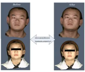 Figure 14. Microdermabrasion contrast effect image. 