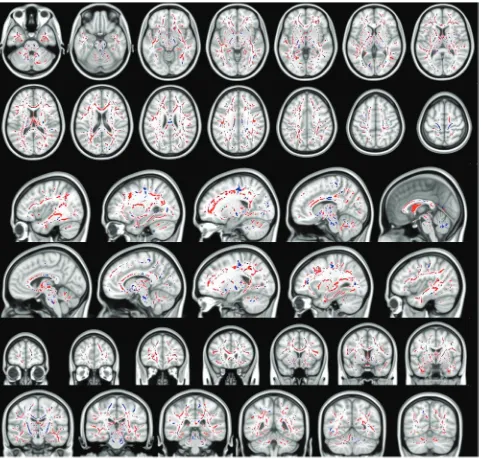 Fig 2. Blue voxels show the regions within and outside the CST, where the FA is significantly reduced in patients with ALS with T1 MTC hyperintense signal intensity compared with patientswith ALS with T1 MTC hyperintense signal intensity compared with pati