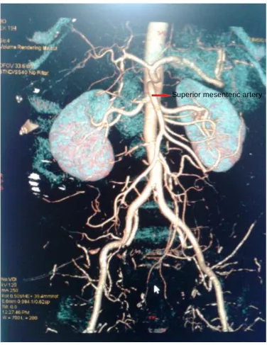 Fig. 4 Superior Mesenteric Artery (CT Angiogram) 