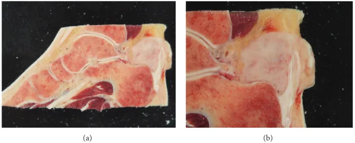 Figure 2: Sagittal sections of the ankle region of the amputated specimen (Case 1) showing the (clear cell) sarcoma involving the Achillestendon with a close relation to the calcaneus but without macroscopically visible invasion of the bone.