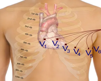 Figure 2.4: placement of the precordial leads in electrocardiography [41]