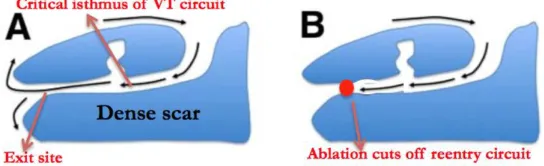 Figure 2.6: Wol↵ Parkinson White Syndrome abnormal activation [55]