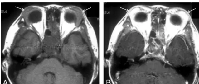 Fig 3. KD involving bilateral buccal spaces in a 52-year-old man. A, Axial T1-weighted MR image demonstrates ill-defined soft-tissue masses in the bilateral buccal spaces, isointenseto the adjacent muscle