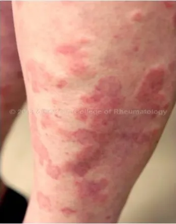Fig 11. Urticarial Rashes