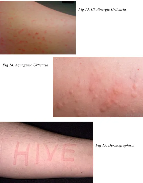 Fig 15. Dermographism