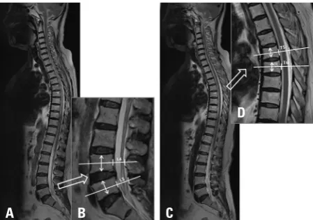 Fig. 1. Radiologic parameters of whole spine sagittal MRI. From the whole spine sagittal MRI, we selected the largest spinal canal image at the lum-bar spine (A)