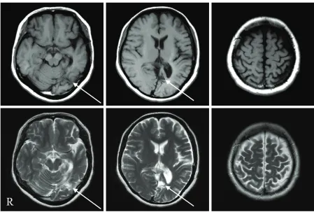 Figure 1: The upper sections are T1-weighted MR images, and the lower sections are T2-weighted MR images