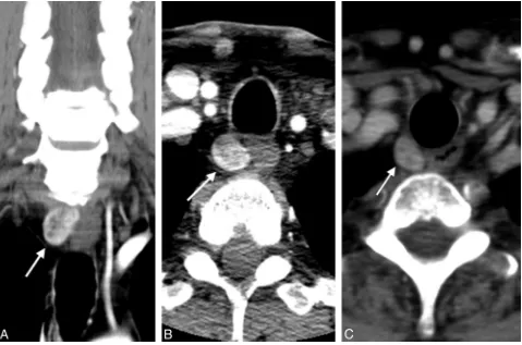 Fig 1. Axial noncontrast (A), axial early phase postcontrast (B), and axial delayed phase postcontrast (C) images show a hypoattenuated hypodense nodule contiguous with the left posteriorthyroid gland, which demonstrates avid early contrast enhancement and