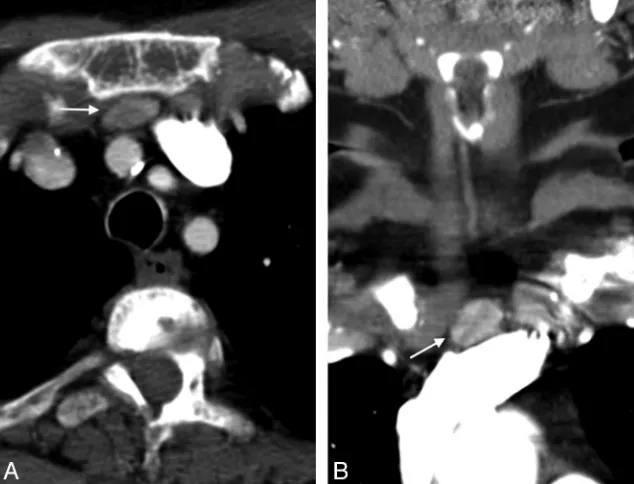 Fig 3. Axial (A) and coronal (B) postcontrast images showing an enhancing retrosternal ectopic parathyroid adenoma.
