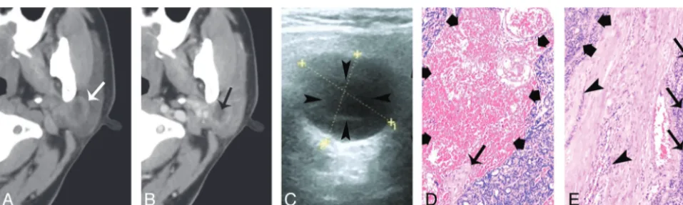 Fig 1. A 55-year-old man with type 1 BCA in the right parotid gland A, and B, CT shows a round, well-defined, homogeneously enhancing lesion in the superficial region of the right parotidsuperficial lobe