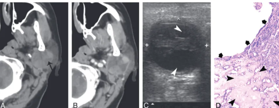 Fig 5. A 73-year-old man with type 3 BCA in the left parotid gland.enhancement on contrast CT scan