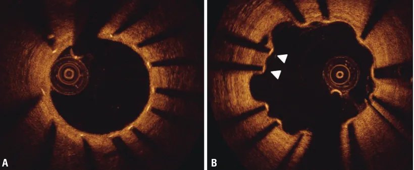 Fig. 1. Representative images of well-apposed vs. malapposed struts. Optical coherence tomography shows well-apposed struts with complete coverage 9 months after drug-eluting stent implantation (A), whereas some struts (arrowheads) show incomplete stent apposi-tion and uncovered portions to the lumen (B).