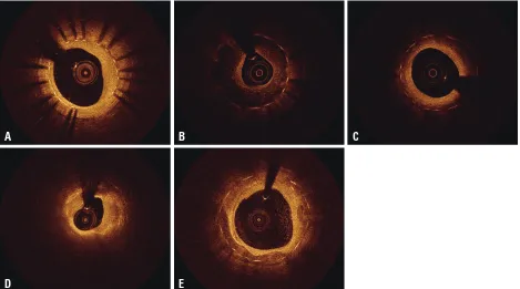 Fig. 3. Various patterns of neointimal tissue. (A) Homogeneous pattern, (B) heterogeneous pattern, (C) layered pattern, (D) lipid-laden neointima, (E) neointi-ma with calcification.