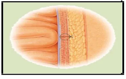 FIGURE 14 : LAPAROSCOPIC HERNIA REPAIR 