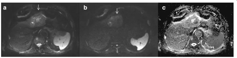 Fig. 2 High-grade HCC. DWI sequences: in A b50 s/mm2; in B b800 s/mm2 and in C ADC map