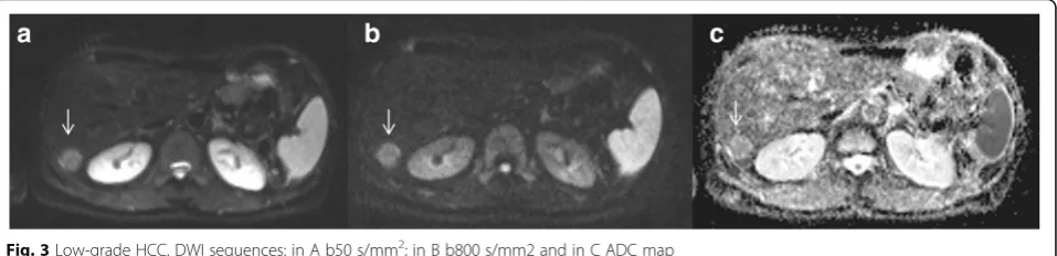 Fig. 3 Low-grade HCC. DWI sequences: in A b50 s/mm2; in B b800 s/mm2 and in C ADC map