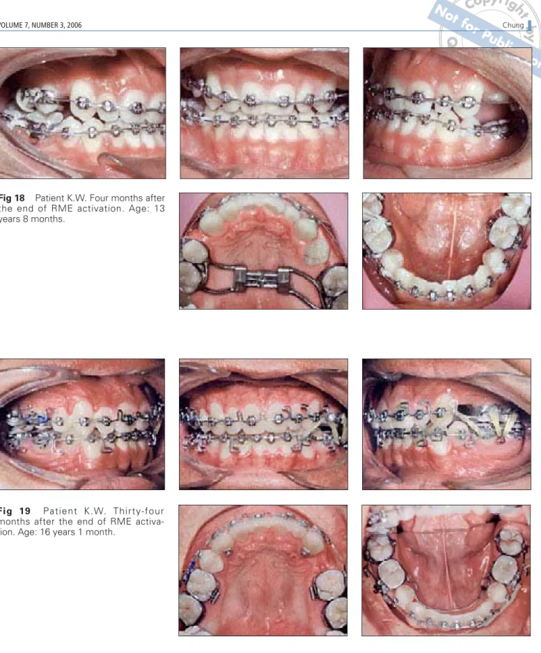 Fig 18 Patient K.W. Four months after the end of RME activation. Age: 13 years 8 months.