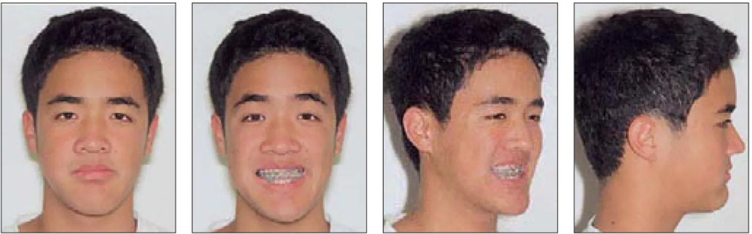 Fig 24 Patient K.W. Thirty-four months after the end of RME activation. Age: 16 years 1 month.
