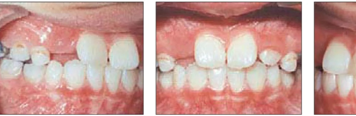 Fig 31 Patient V.S. Thirty-five months after the end of RME activation. Age: