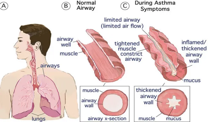 Figure 4: Airway Remodelling 