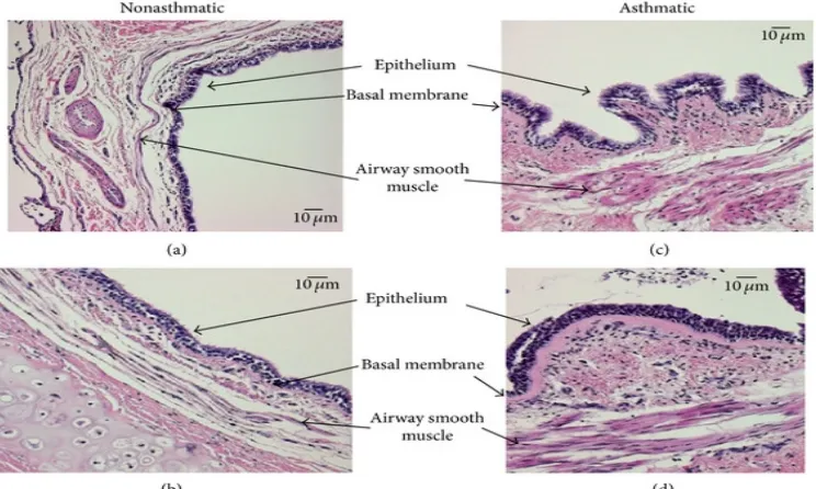 Figure 6: Mucosa Of The Airway In Asthmatics 