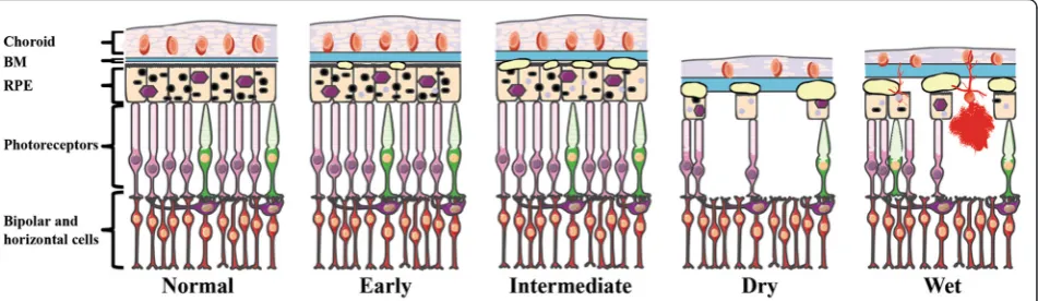 Fig. 1 Illustration of the anatomical retinal pathology associated with the various AMD subtypes