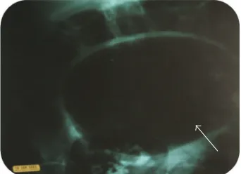Figure 1: Abdominal X-ray showing air fluid level with a dilatedloop of sigmoid colon.