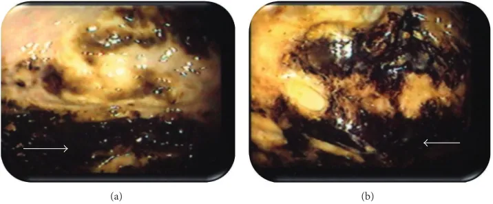 Figure 2: ((a), (b), and (c)) Abdominal CT showing air fluid level with a dilated loop of sigmoid colon.