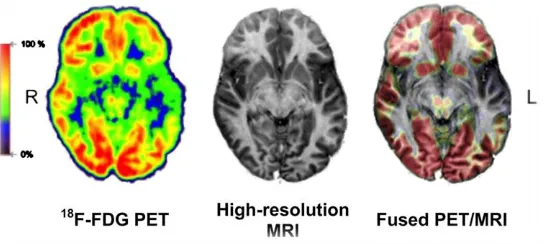 Figure 5. An example of individual PET and MRI scans, and the fused image of the two scans, showing the high-resolution structure and the sensitive biological activity information which can be obtained from such an image.36 