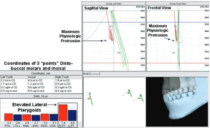 Table 1: Summary of associated mandibular coordinates relative to physiologic parameters, determined by simultaneous monitoring ofmasticatory muscle activity.